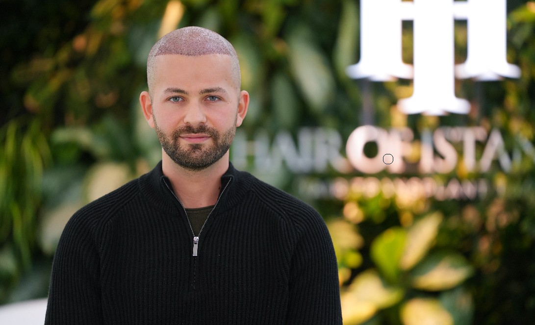 Hair transplant is surging: the focus is patient safety, natural design and long-term planning